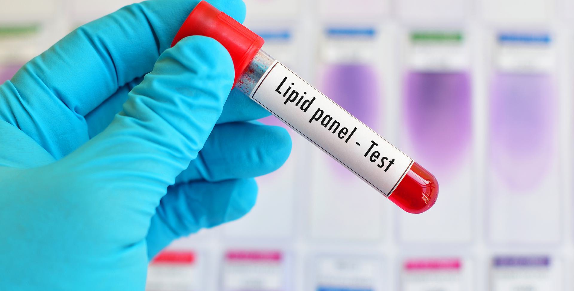Lipid Profile (Cholesterol Panel)