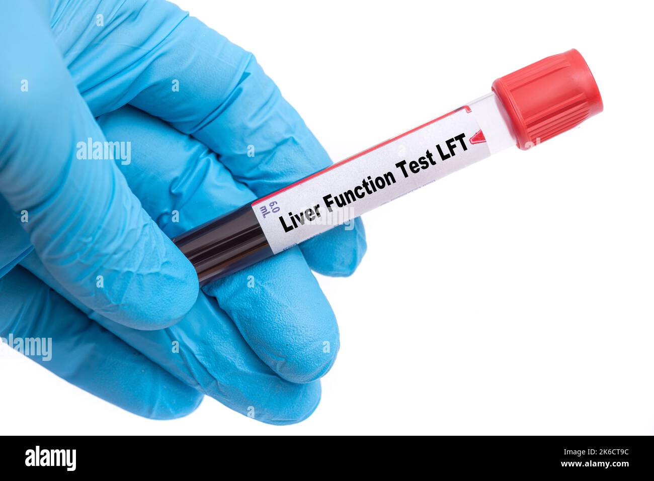 Liver Function Test (LFT)